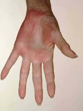 red hands - Symptoms, Treatments and Resources for red hands
